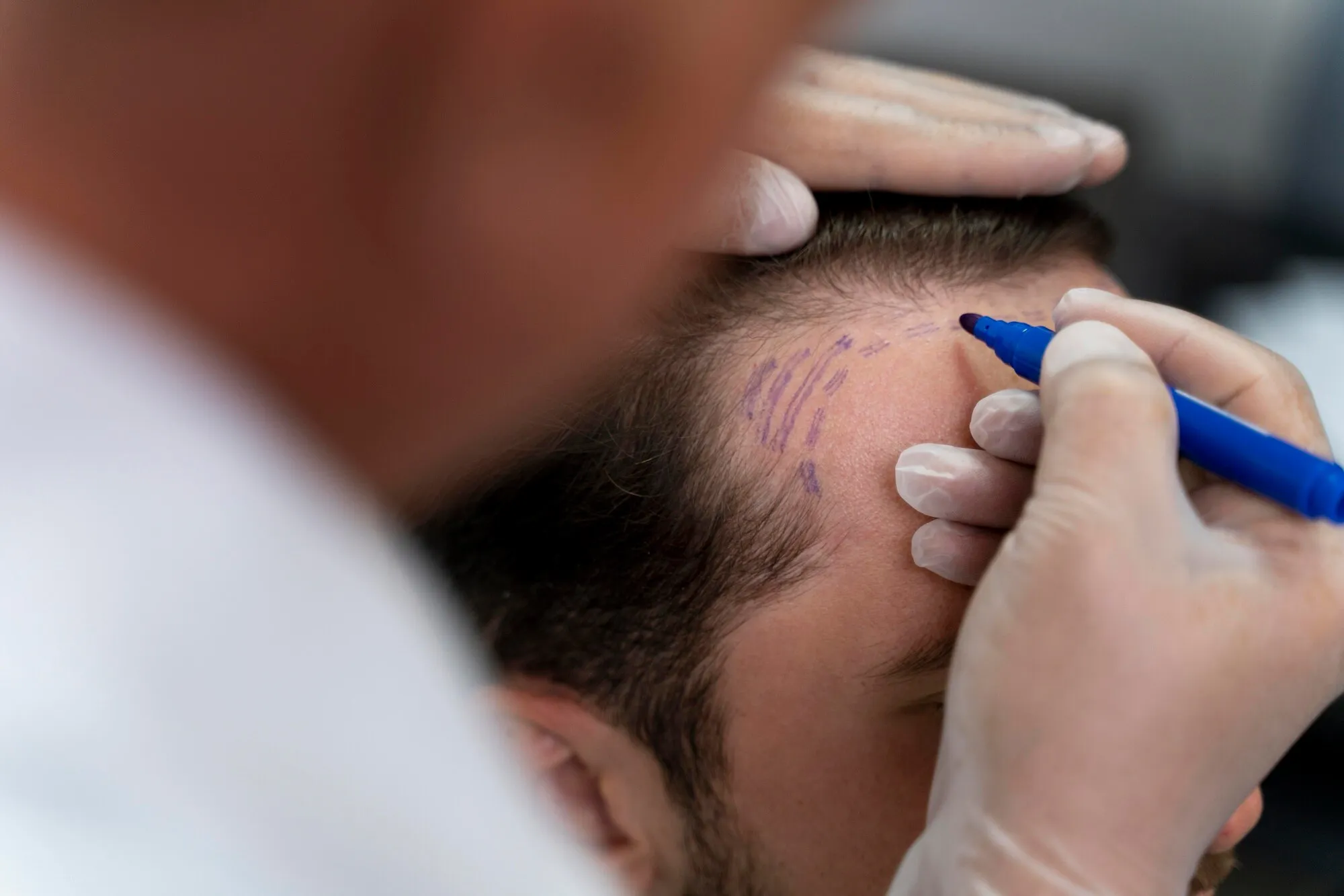 imgi_8_adult-male-doing-follicular-unit-extraction_23-2149106336