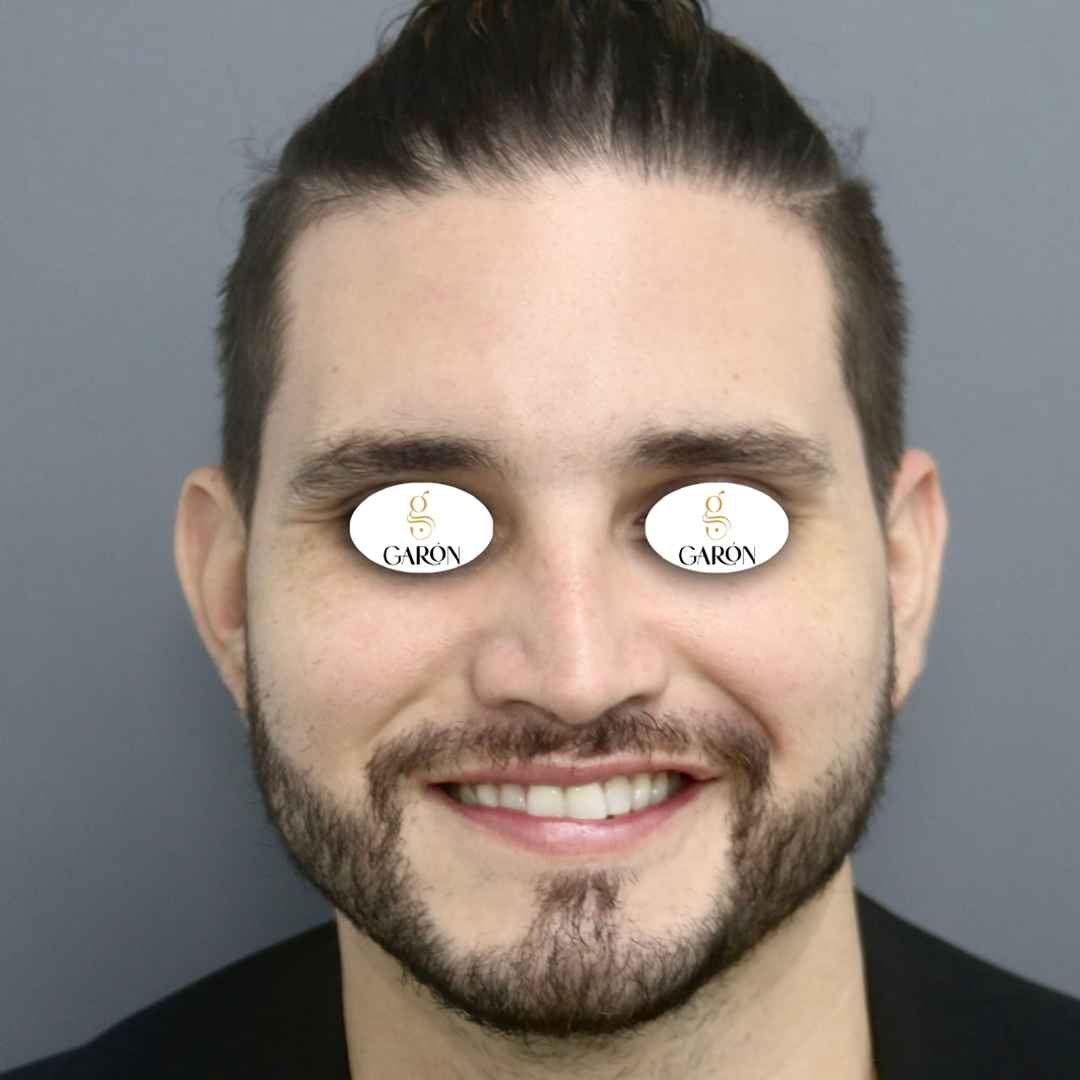 1 después (1)